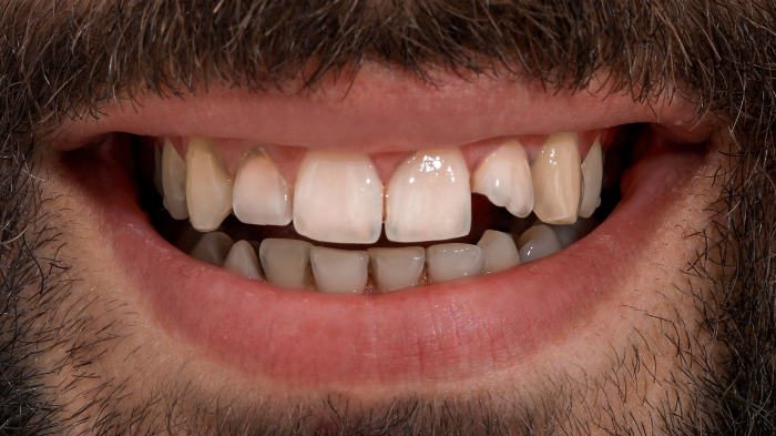 Collage with photos of young man before and after dental treatme Collage with photos of young man before and after dental treatment, closeup. Banner design