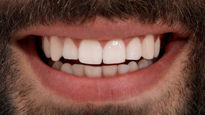 Collage with photos of young man before and after dental treatment, closeup. Banner design